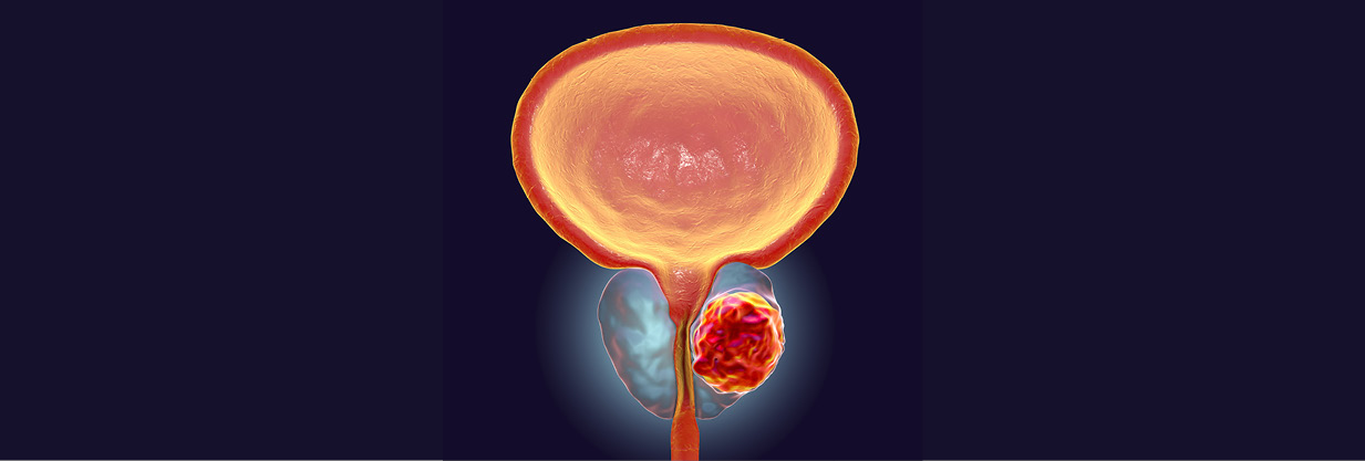 Forum för SSK inom prostatacancer